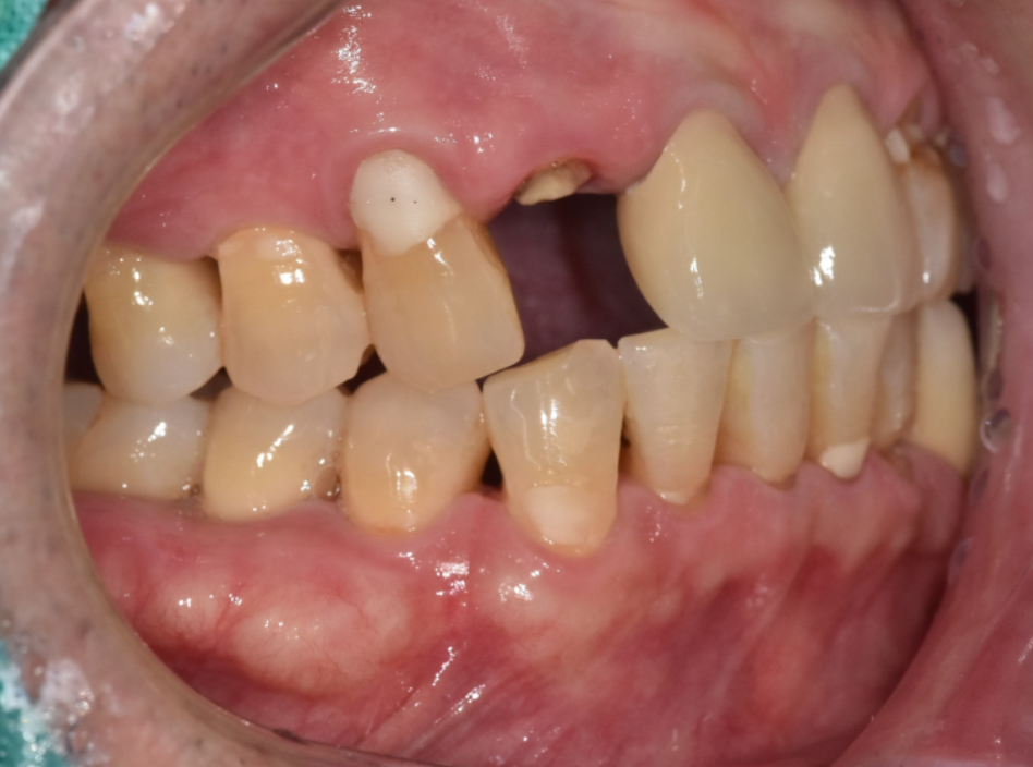 크라운 탈락 빠짐, 빠졌을 때 그대로 다시 붙일 수 있나요? 관련 이미지 7