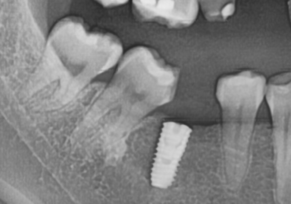 No space for an implant because a tooth has fallen over or a molar has tilted? Read this first. image 8