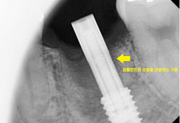 상일동역 치과에서 알려드리는 임플란트 수술과정 대공개 관련 이미지 9