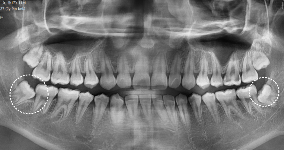 상일동 사랑니 매복 방치하다 옆 치아까지 망가진 실제 사례 관련 이미지 1