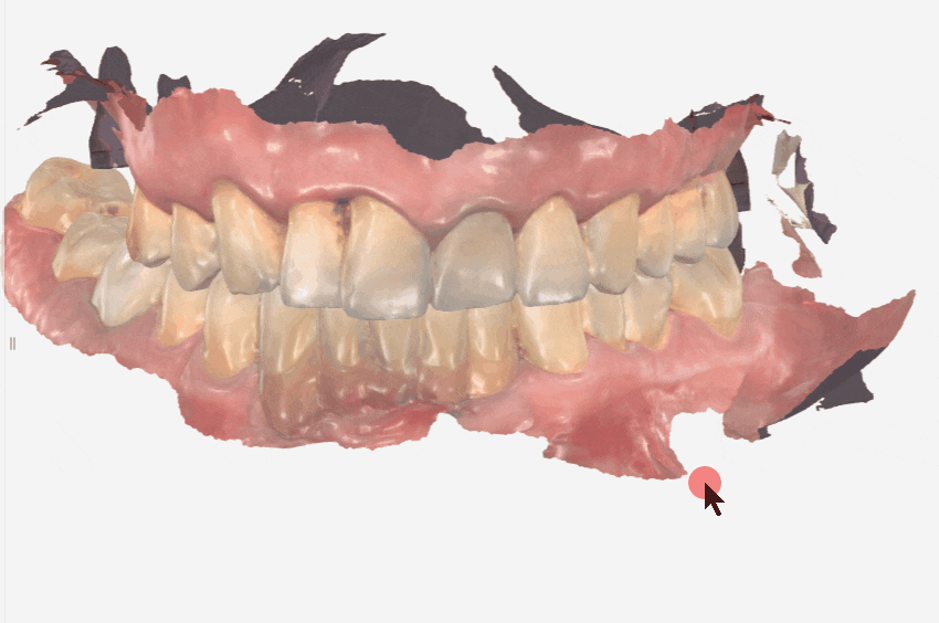 잇몸 고름 눌러보니 푹... 임플란트 주위염 방치했다가 재수술한 사례 관련 이미지 16