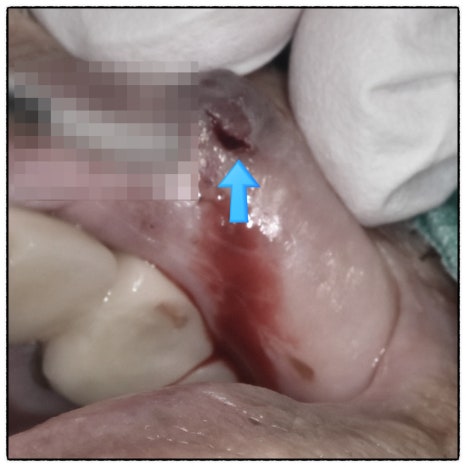 입술에 검은 점이 생겼는데 없앨 수 있나요? 입술 정맥호 혈관종 제거 관련 이미지 3