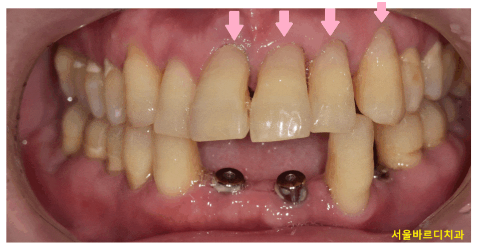 치아 옆면 파임 치경부마모증 치료해주어야하는 이유는? 관련 이미지 1