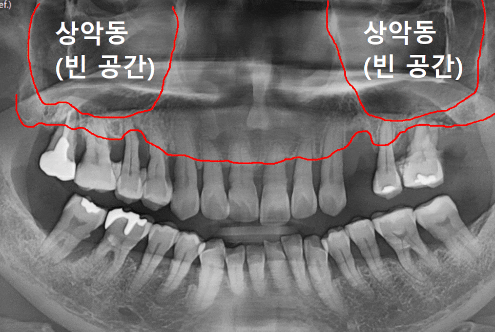 상악동 거상술 부작용 걱정되시나요? 재수술 없는 뼈이식의 정석 공개 관련 이미지 1
