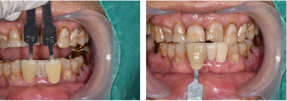 서울바르디치과 무절개 네비게이션 임플란트 치료증례 #8 관련 이미지 7