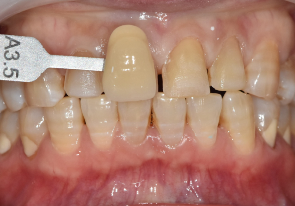 앞니 변색, 치아미백효과 없는 이유 솔직하게 말씀드립니다. 관련 이미지 7