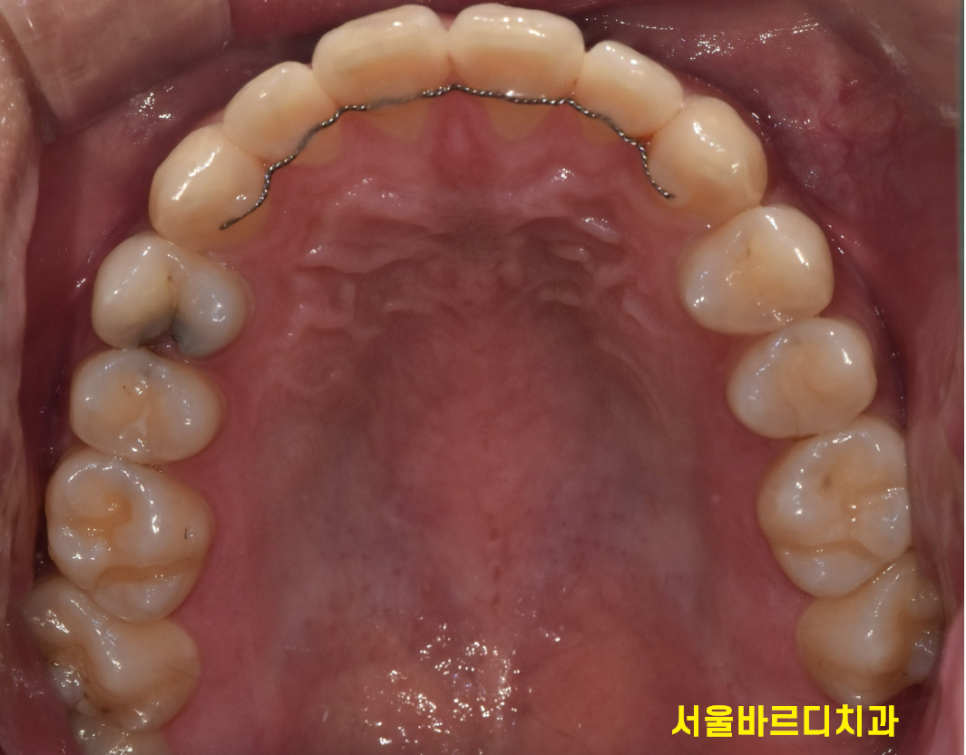 고덕동 치아교정 유지장치는 부정교합 재발을 막기위한 필수입니다! 관련 이미지 3