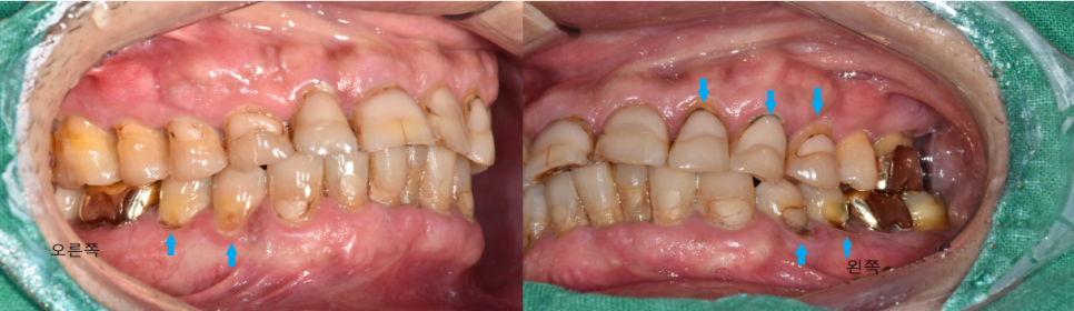 서울바르디치과 무절개 네비게이션 임플란트 치료증례 #8 관련 이미지 3