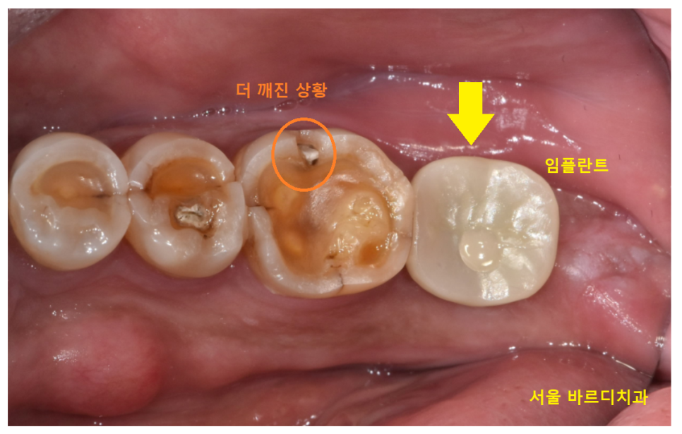 어금니 금감 발치 후 임플란트 풍산동 치과에서 진행했습니다. 관련 이미지 8