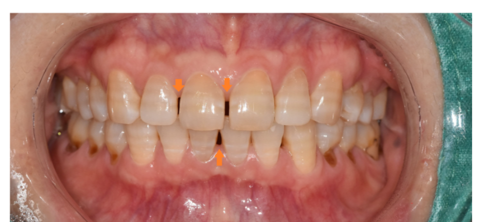 mta 장치 교정 앞니만 빠르게 심미적으로 정리할 수 있습니다. 관련 이미지 3