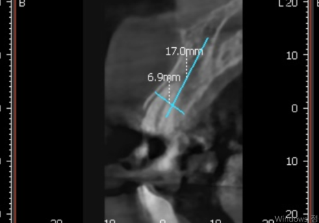 고덕동 앞니 보철, 브릿지와 싱글 크라운, 어떤 선택이 나에게 더 유리할까? 관련 이미지 14