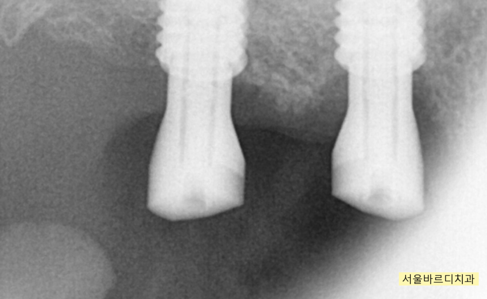 위아래 임플란트 동시에 하여 치료기간 단축하기 관련 이미지 6