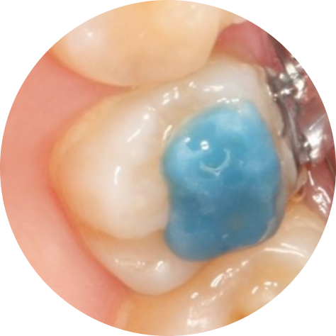 Blue Bite Blocks for Orthodontic Treatment: Everything You Need to Know, Organized image 3