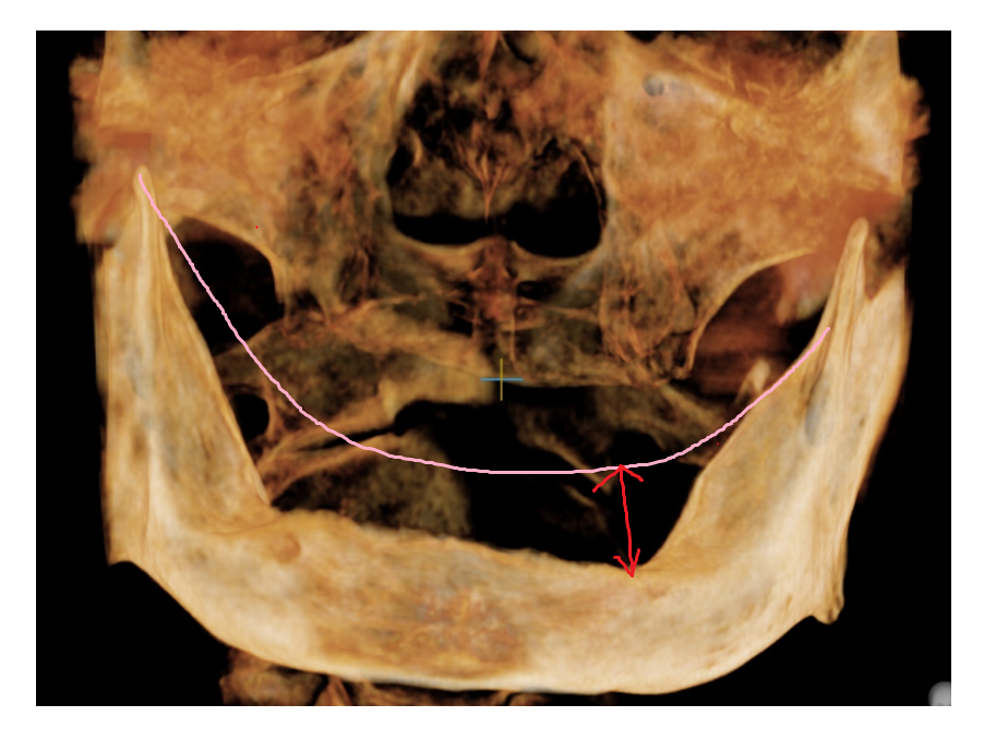 임플란트 불가능한 경우 3가지 경우는? 관련 이미지 2