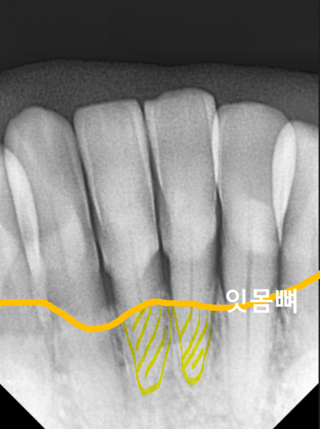 고덕동 아래 앞니 임플란트 비용 줄이는 비법, 공개합니다. 관련 이미지 6