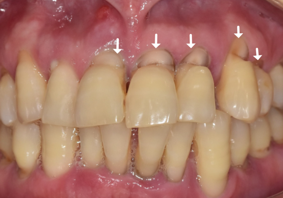 치아 시림 증상 때문에 고민이신가요? 그렇다면 양치질 너무 열심히 하지 마세요. 관련 이미지 8