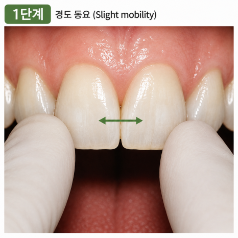 상일동역치과 흔들리는 치아 무조건 뽑아야 할까요? 관련 이미지 3