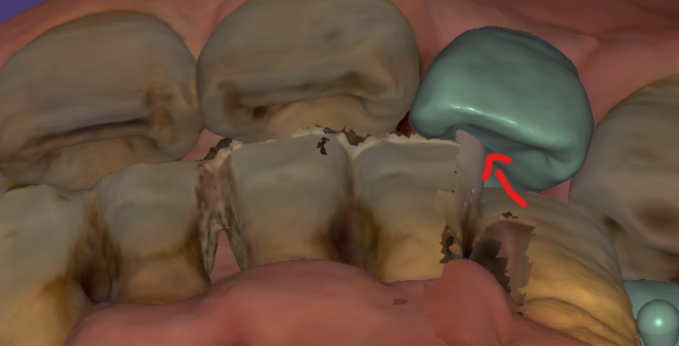 하남시청치과 디지털 임플란트를 고집하는 이유 관련 이미지 13