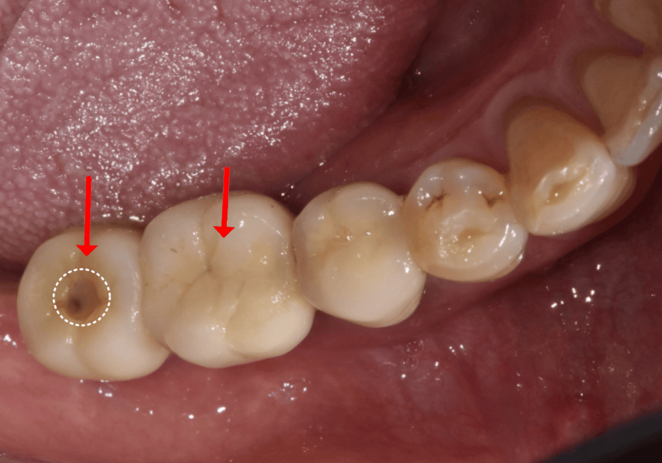 고덕 치과, 임플란트가 흔들려요. 뽑아야 할까 봐 고민이라면? 이렇게 해결합니다. 관련 이미지 4