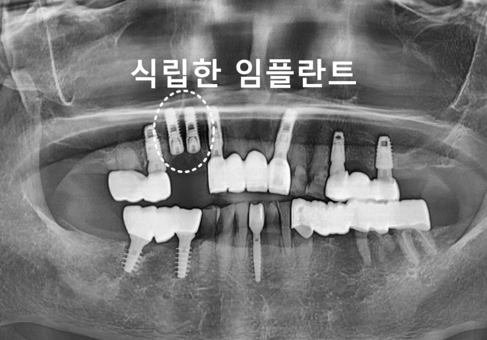 상일동 임플란트 심한 충치로 인한 치아 부러짐 해결한 사례 관련 이미지 8