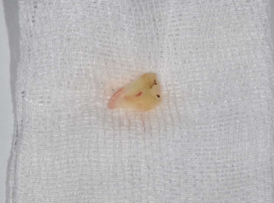 초이동 치과 치아 실금으로 조각나 신경치료까지 진행했습니다. 관련 이미지 5