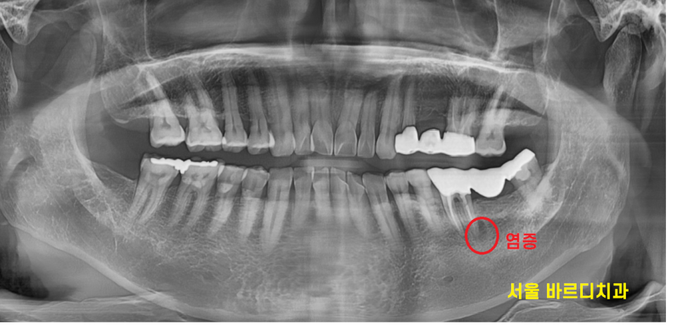 강일동 임플란트 씌운 치아 통증 불편할 때는 치과를 방문해주세요 관련 이미지 2