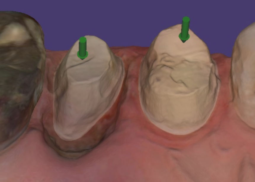 강동역 치과 3000만원의 값어치 구강스캐너를 사용합니다. 관련 이미지 5