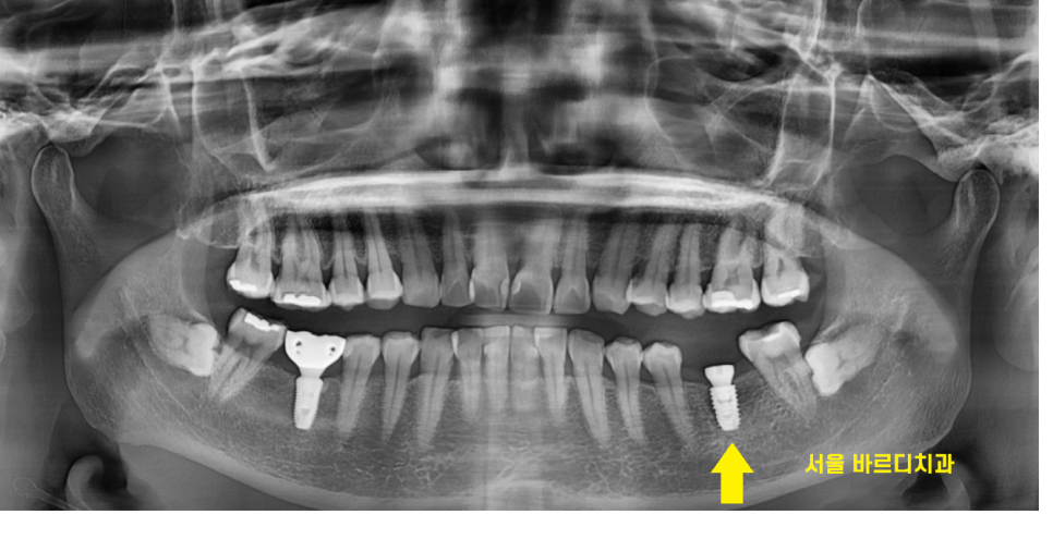 풍산동 치과 아래 어금니 임플란트 뼈 이식 없이 해결했습니다. 관련 이미지 6