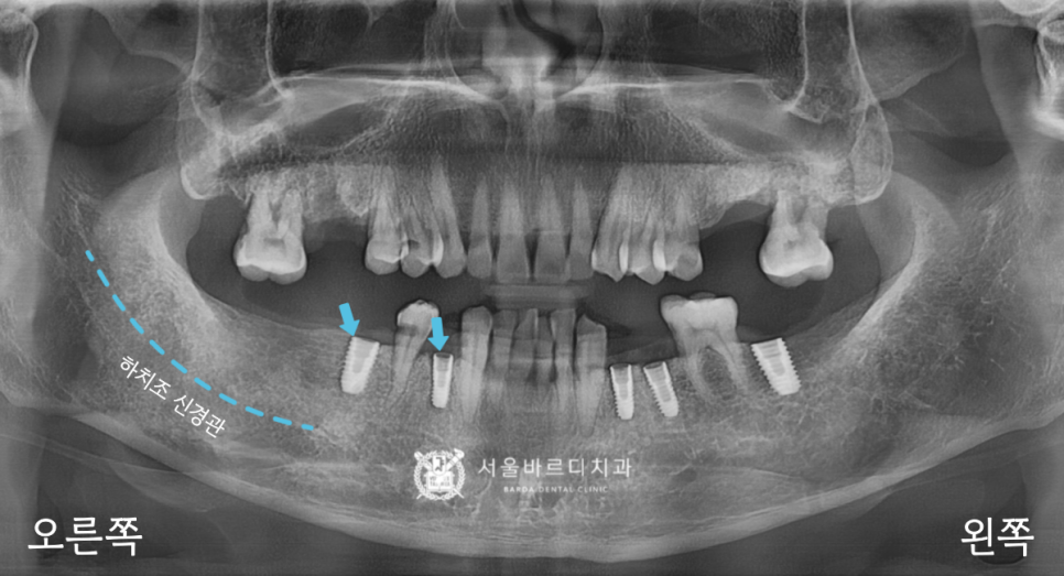 고덕동치과 서울바르디치과 무절개 네비게이션 임플란트 치료증례 #1 관련 이미지 10