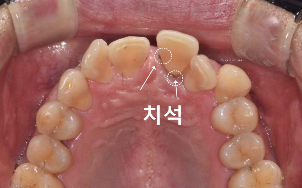 잇몸 내려감으로 길어진 치아, 방치하면 안 되는 원인, 증상, 이유 관련 이미지 6