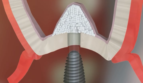 If you lightly brush your backmost molar because the toothbrush can’t reach it, this is what happens. image 13