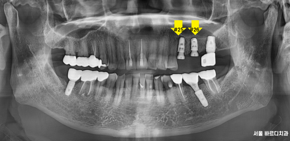 하남 미사 치과 발치 후 당일 임플란트가 가능합니다. 관련 이미지 6