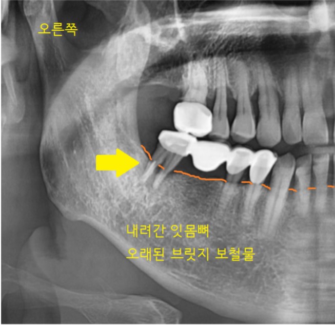 오래된 브릿지 보철 제거 후 고덕역 임플란트 교체 케이스 관련 이미지 4