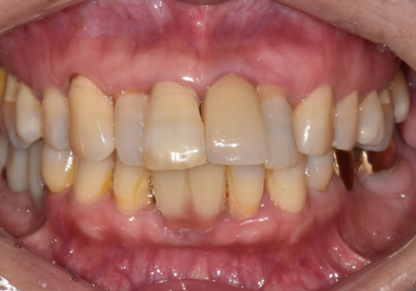 고덕동 임플란트, 튀어나온 앞니, 비용은 줄이고 자연스럽게 개선한 실제 사례 관련 이미지 1