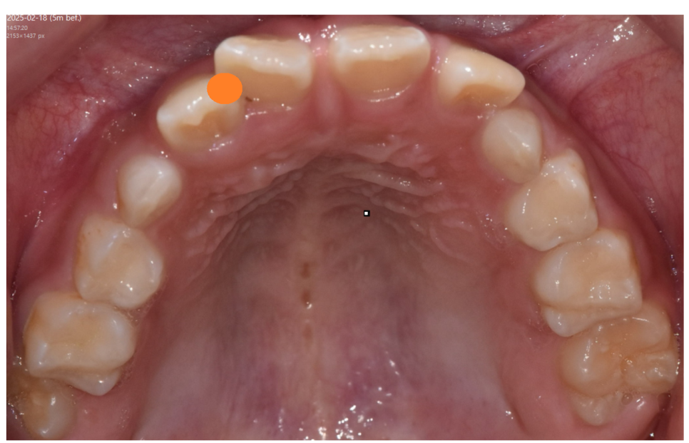 어린이 덧니 교정 걱정되신다면 이 글 꼭 보세요! 적정 시기는? 관련 이미지 5