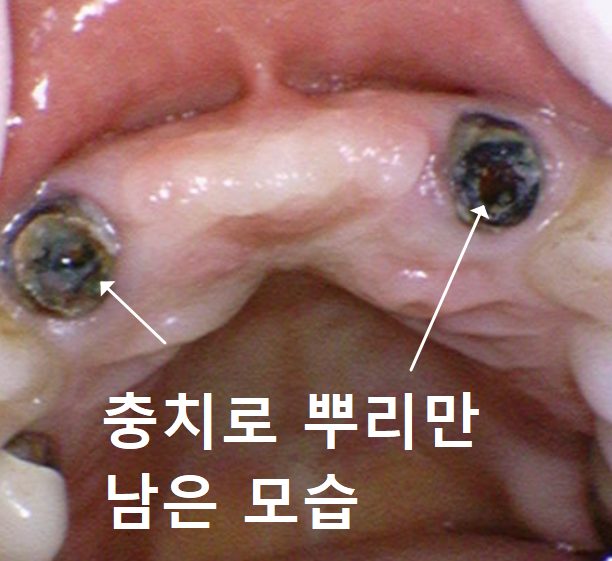 명일동 앞니 브릿지, 새로 교체 할 때 꼭 확인해 봐야 할 관련 이미지 6