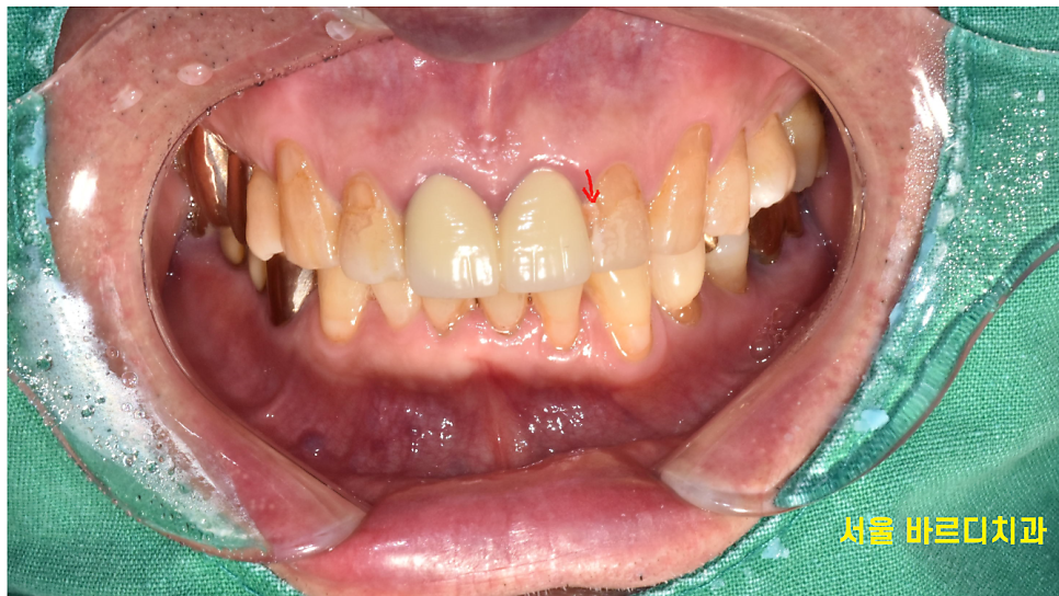 미사역 치과 앞니 충치 레진으로 당일 수복 완료하였습니다. 관련 이미지 3