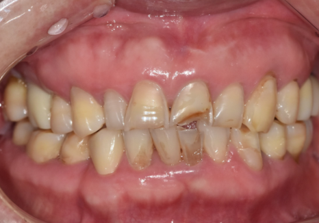 명일동 라미네이트 vs 크라운, 수명을 좌우하는 선택 기준 3가지 관련 이미지 12