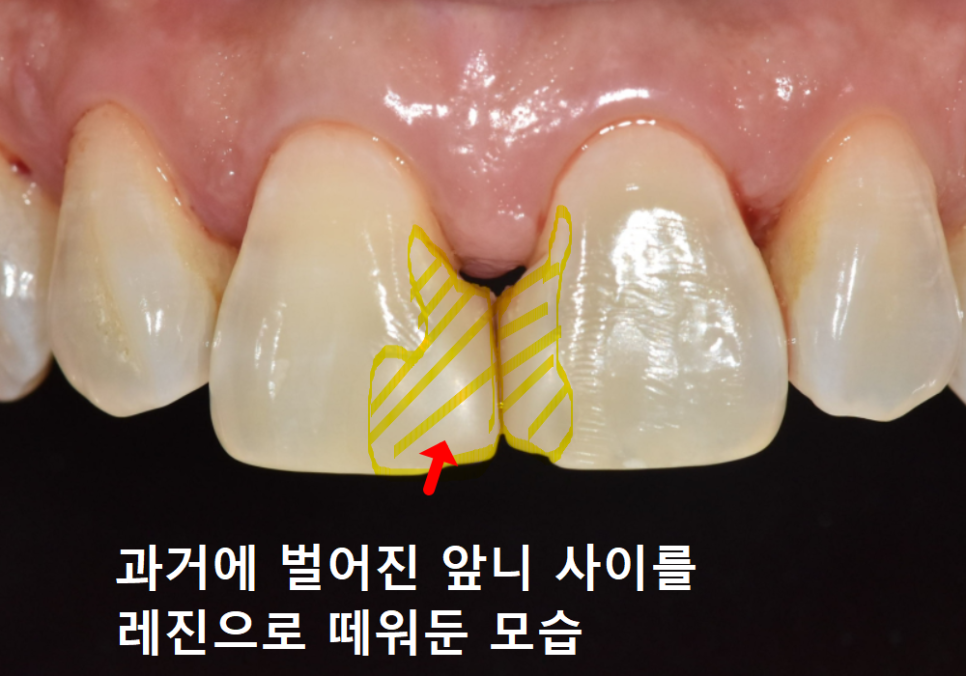 고덕동 치과 누런 이, 앞니 사이 틈, 잘못된 관리 때문일까? 관련 이미지 3