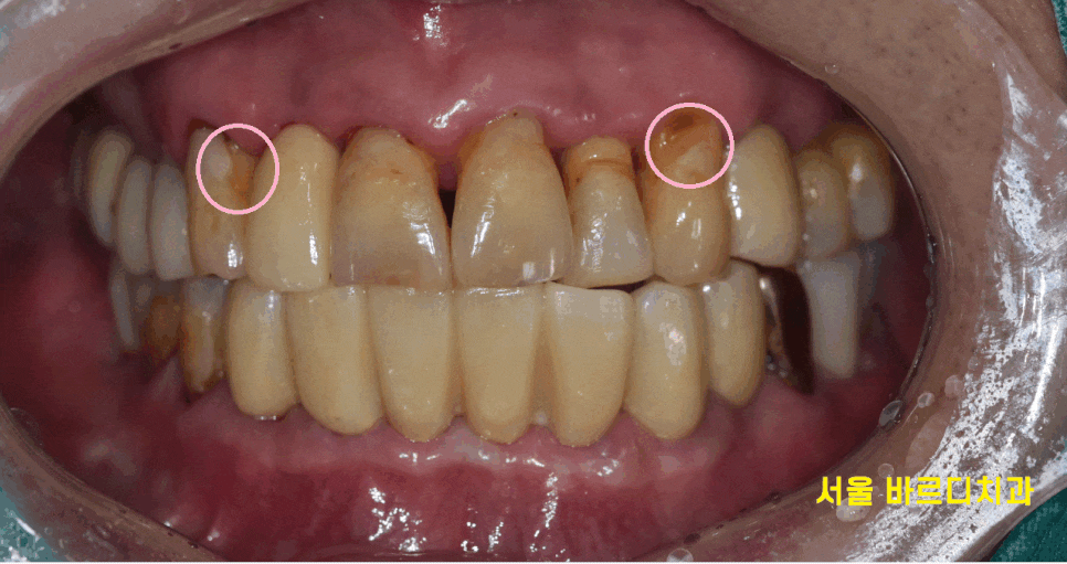 녹아버린 잇몸뼈 흔들리는 여러 치아 발치 후 임플란트 시행 관련 이미지 1