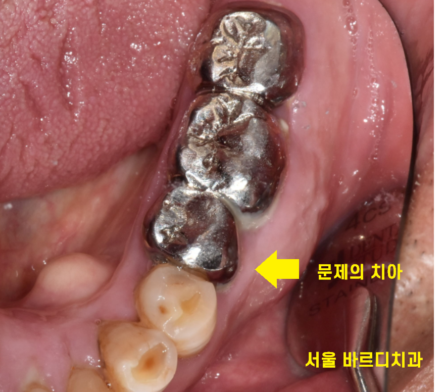 둔촌동 치과 80대 임플란트 가능한가요? 관련 이미지 5