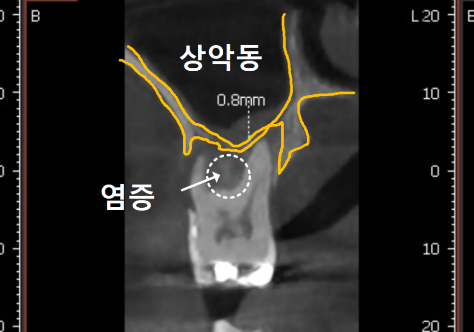 Gangil-dong Molar Implant, "It’s Loose—Can’t You Just Bond It with Resin?" image 10
