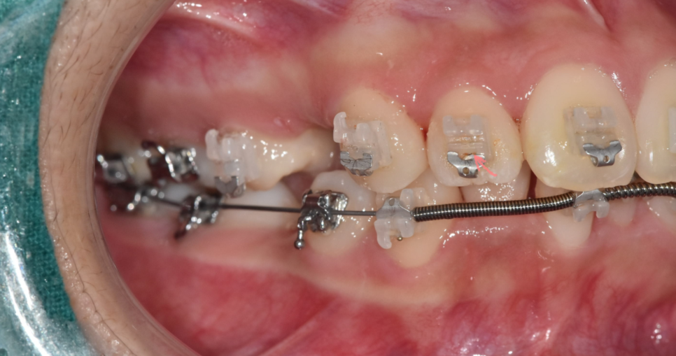 교정 중 충치 치료 먼저? 계속 방치? 알려드립니다. 관련 이미지 4