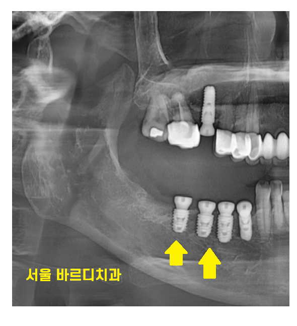고덕역 치과 빠진 어금니 방치 그대로 두다가는 임플란트가..? 관련 이미지 7