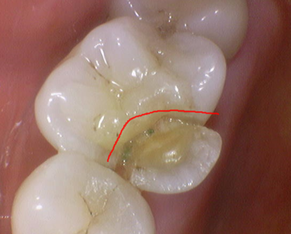 어금니 치아 파절 부러짐 발치까지 이어질 수 있습니다. 관련 이미지 3