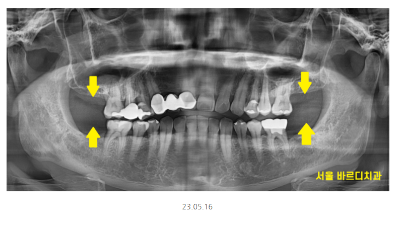 명일동 치과 임플란트 위아래 같이 할 수 있나요?? 관련 이미지 2