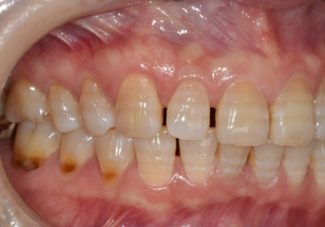 50대 라미네이트, 앞니 벌어짐과 변색 고민 이렇게 해결했습니다. 관련 이미지 4