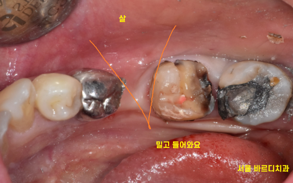 망월동 치과 임플란트 보철 불편 볼 씹힘, 이질감 그 사이에서 관련 이미지 4