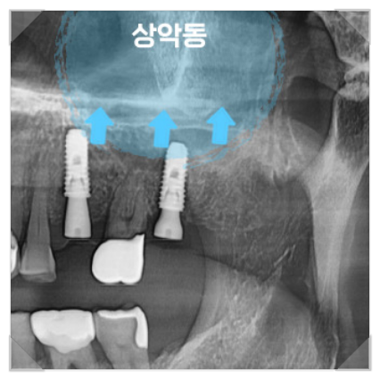 빠진 크라운 크라운 탈락이 알려주는 3가지 신호 관련 이미지 6