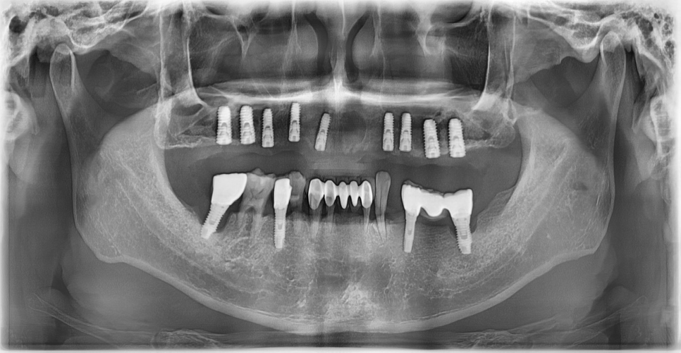 얇은 잇몸뼈, 임플란트 거부 당했다면? 상악동거상술로 해결할 수 있습니다. 관련 이미지 12